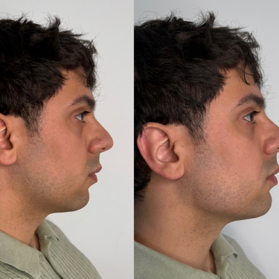 Lymphatic Sculptor™