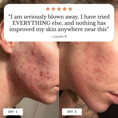 Acne & Redness Killer