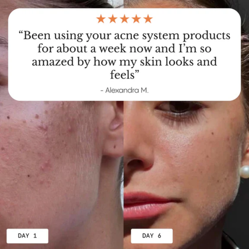 Acne & Redness Killer