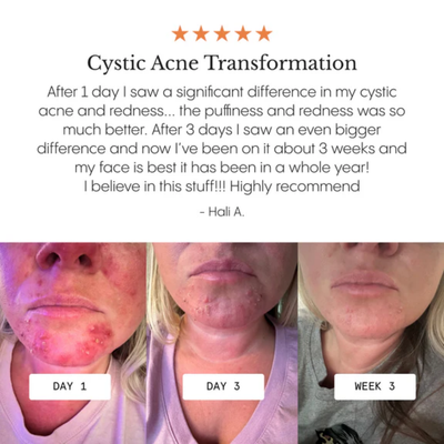 Acne & Redness Killer