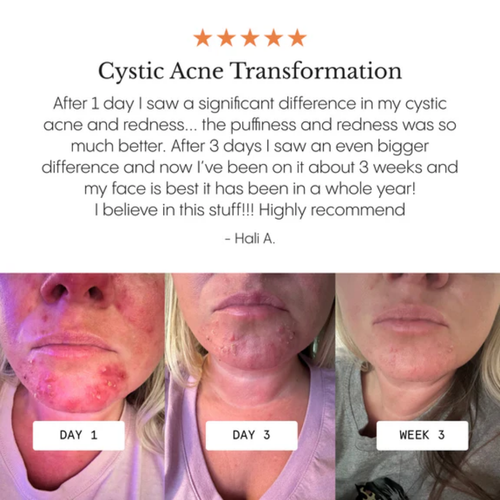 Acne & Redness Killer