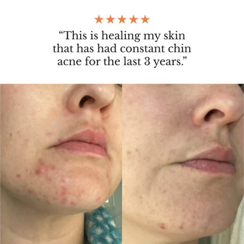 Acne & Redness Killer
